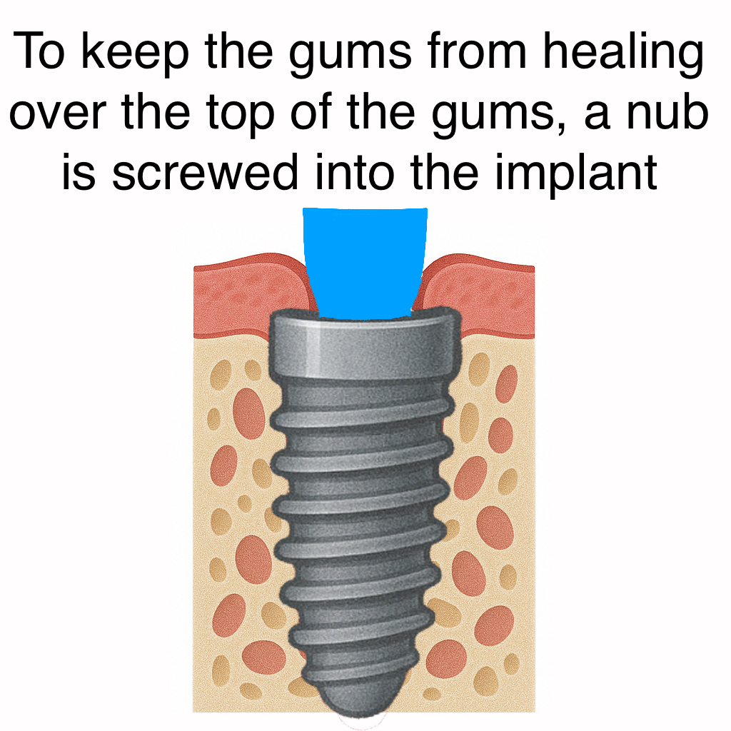 implantnext2